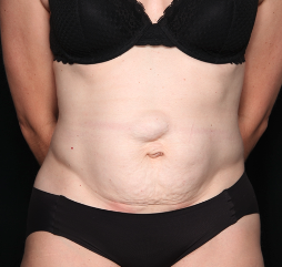 Tummy Tuck Before & After Patient #34348